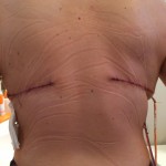 Back scars