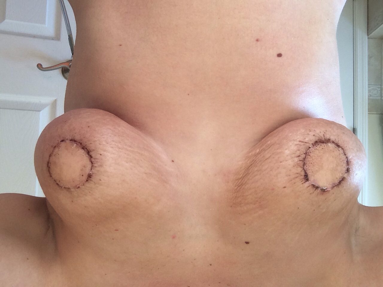 разрывы на грудях у женщин фото 34